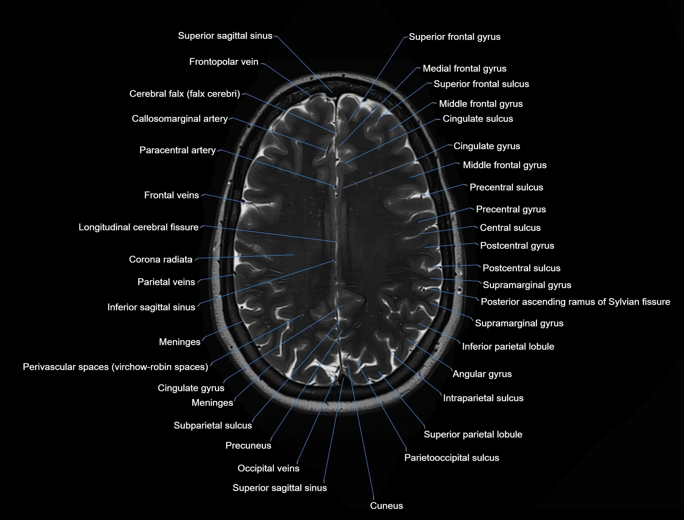 MRI Brain axial cross sectional radiology anatomy 3T image  -img-00001-00040.webp